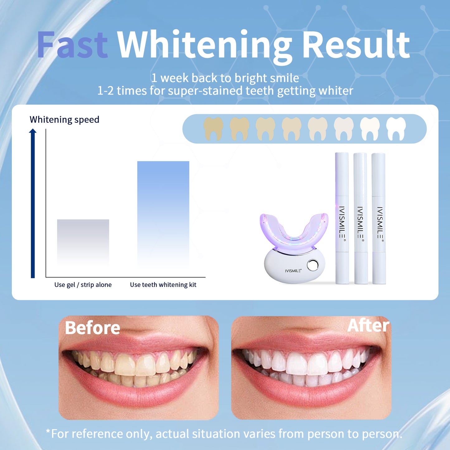 Professional Home Teeth Whitening Kit